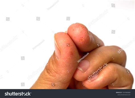 close dyshidrotic eczema dyshidrosis symptoms  stock photo