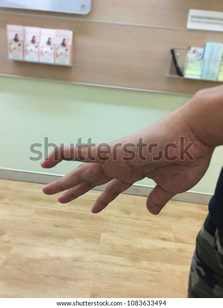 2 Finger Tip Avulsion Images, Stock Photos, 3D objects, & Vectors ...