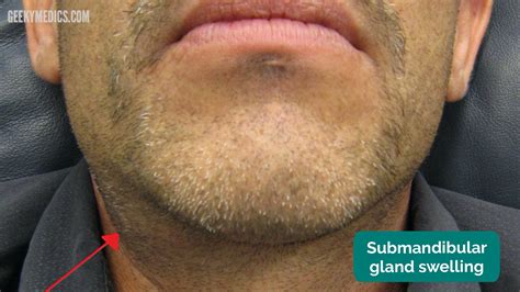 Neck Lump Examination - OSCE Guide | Geeky Medics
