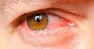 आंख आने या लाल पड़ जाने पर (Allergic Conjunctivitis) || निरोगधाम