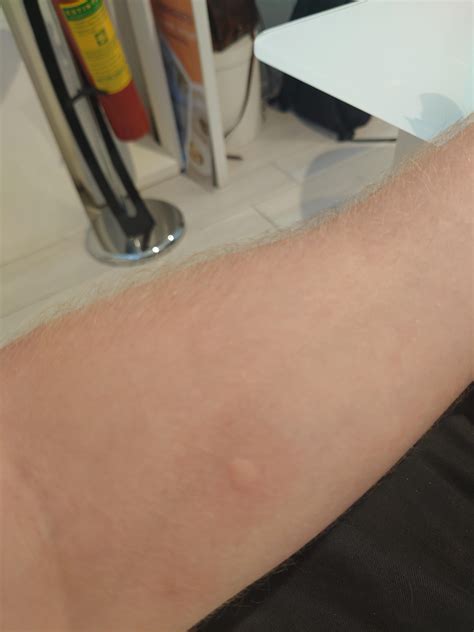 i suddenly got this small bump on my arm, it doesn't itch, what could