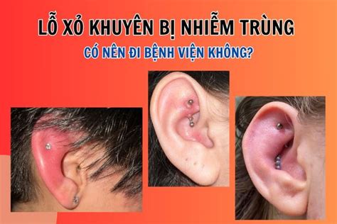 lo xo khuyen bi nhiem trung  nen  benh vien khong