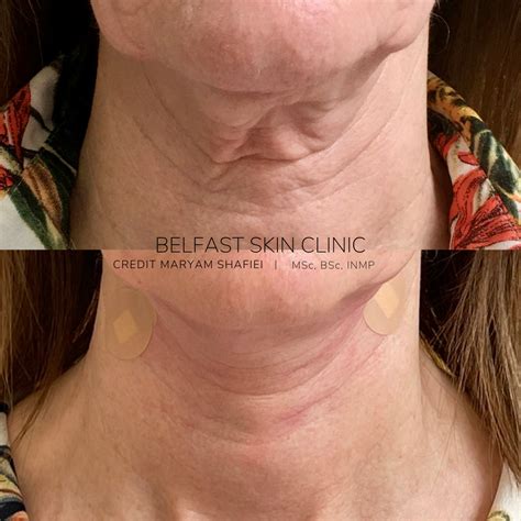 thread lift  neck     dalton finn blog