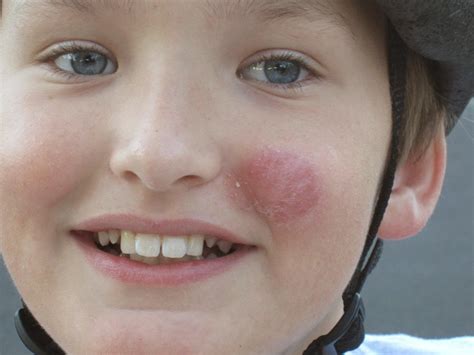 pictures of ringworm on face - pictures, photos