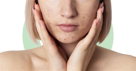 Hormonal Acne: Types, Causes, And Treatment | Ova SG