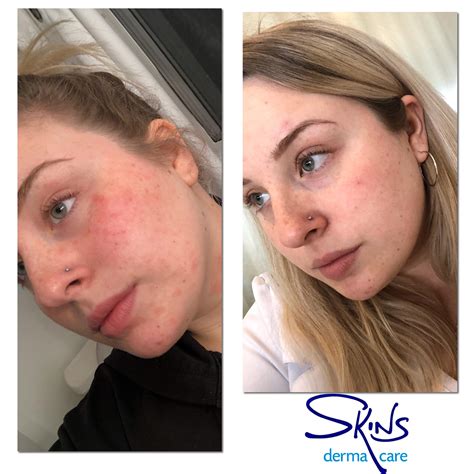 Amazing!!!!! 👏👏👏 COLOSTRUM Gel 1 week... - SKINS Derma Care | Facebook