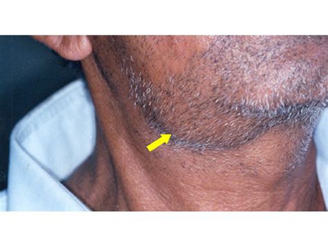 Submandibular Lymph Nodes Swollen
