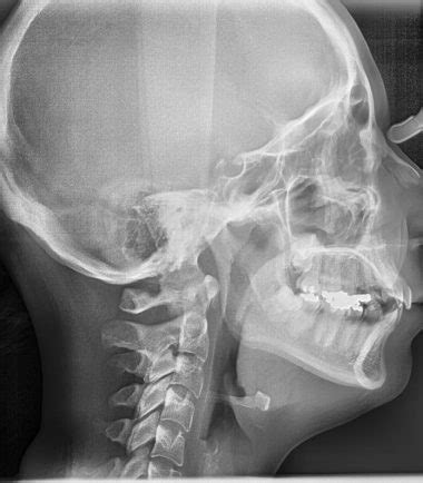 LATERAL CEPHALOGRAM 1 | Buyxraysonline