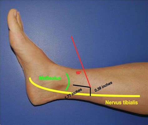The percutaneous posterior tibial nerve stimulation point | Download ...