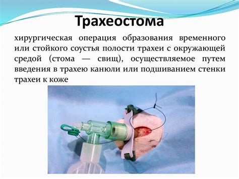 Трубки, спасающие нашим пациентам жизнь - презентация онлайн