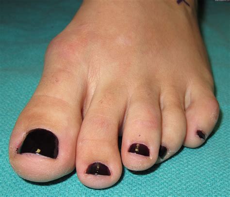 Part II: British Hammertoes are “Wonky Toes”! Before and After Pictures