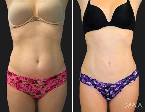 Stomach Liposuction Before And After Women