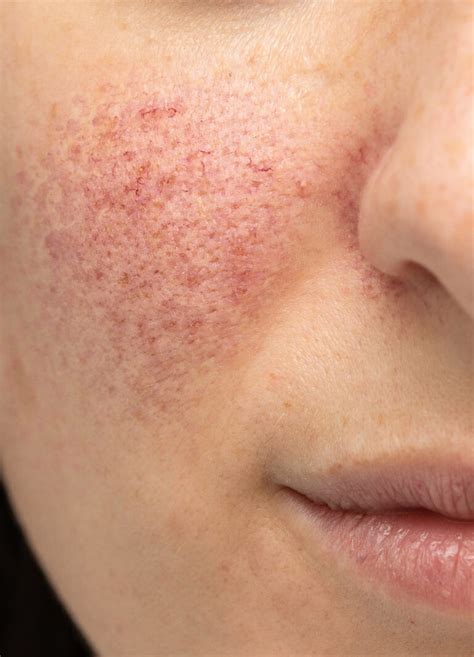 Rosacea Procedures - SomaSou Med Spa