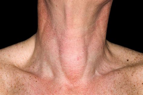 Cancerous Cyst On Neck