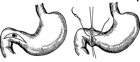 Язвенная болезнь 12-ти перстной кишки — surgery-first.ru
