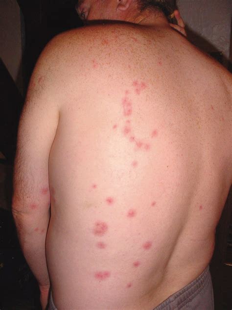 On the rise worlwide: Bed Bugs and Cimicosis | British Journal of