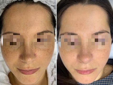 PRX T33 - Wink Medical Aesthetics Wink Medical Aesthetics