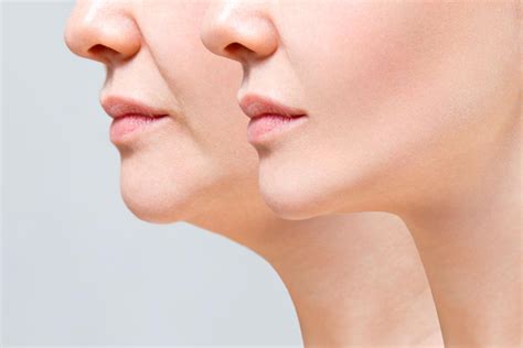 Chin Augmentation - Health & Beauty Turkey