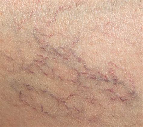 Spider Veins - medAge Aesthetics & Wellness