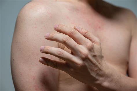Skin Rash Treatment Singapore | Ascle Healthcare Group