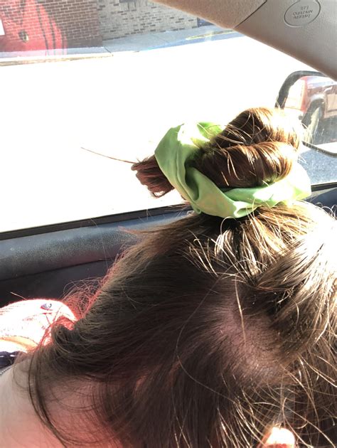 Hair loss is patchy but also diffuse…alopecia areata? Derm just said to