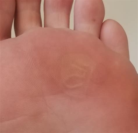 Foot Blister Leaking at Amy Auerbach blog
