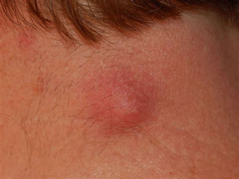 Cancer Tumor On Back Of Neck - CancerWalls