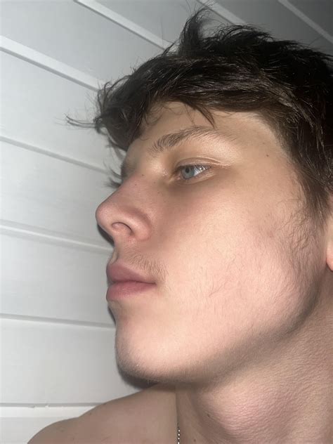 Minoxidil vellus hair : r/Minoxbeards