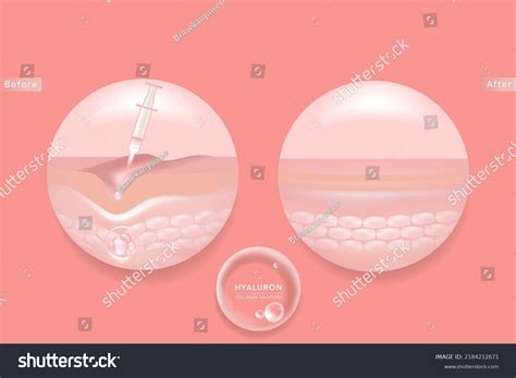 Hyaluronic Acid Before After Skin Solutions Stock Vector (Royalty Free ...