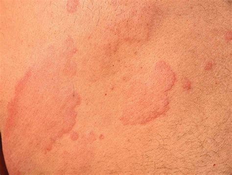 mild hives rash