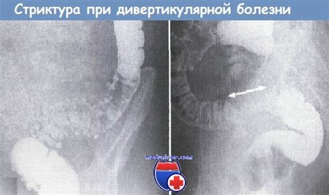 Дивертикулярная болезнь (дивертикулит, дивертикулез) - причины ...