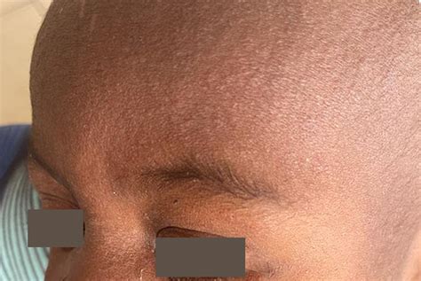 Fotos del sarampión | Measles (Rubeola) | CDC