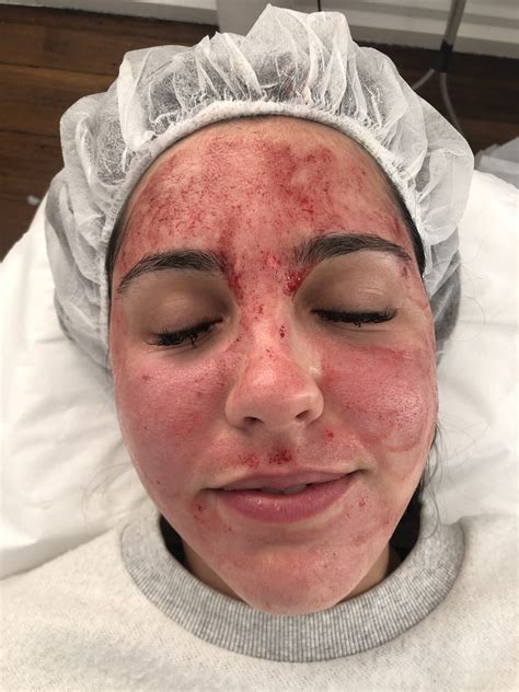 PRP Skin Needling Melbourne - Plasma Therapy