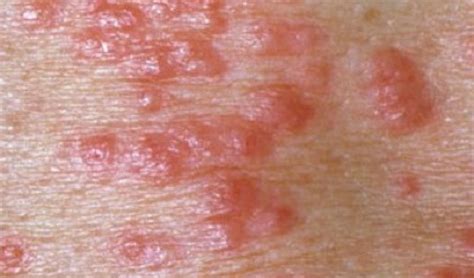 scabies mites control  scabies mites kiwicare