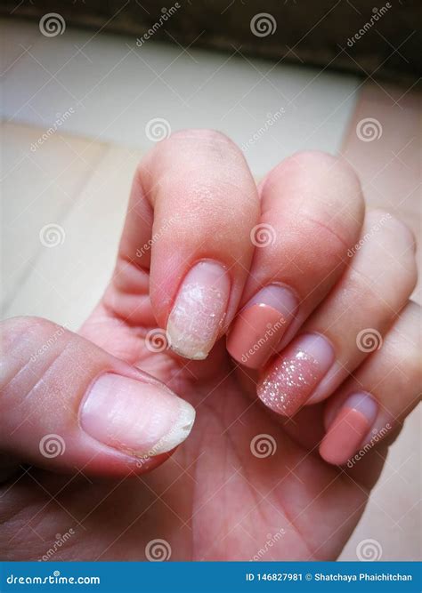 Rash Swelling From Allergic On Arm, Rod Allergy Royalty-Free Stock