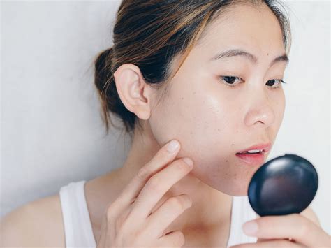 What Is Hormonal Acne? Causes, Treatments, and Remedies | SELF