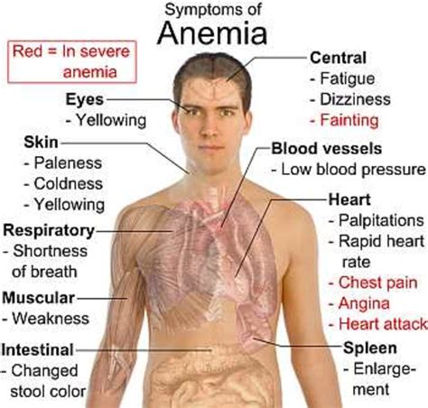 What Is Anemia : Causes, Symptoms, Foods to Cure Iron Deficiency | HubPages