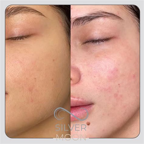 خدمات تزریق prp - مرکز تخصصی زیبایی و پزشکی ماه نقره ای