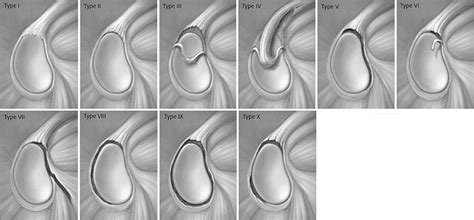 slap lesion part  pathophysiology  diagnosis musculoskeletal key
