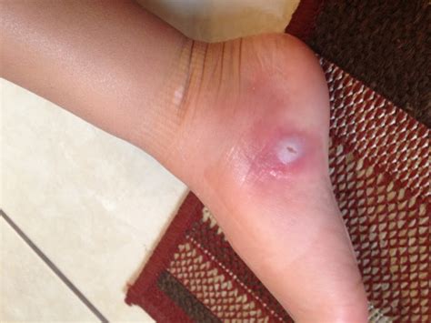 Courtright Family: Strep, Stitches, Staples, and Splinters