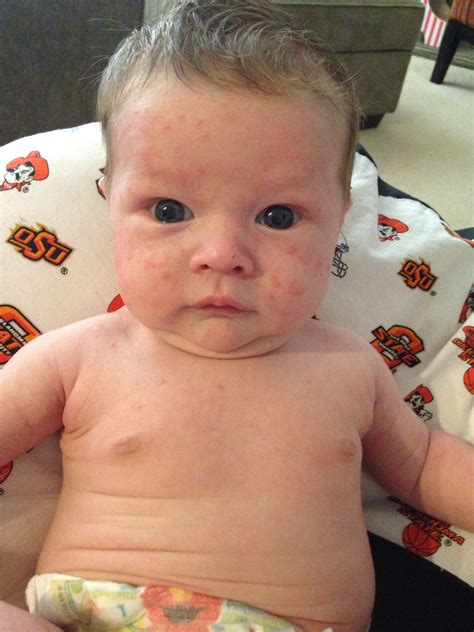 Baby Acne or allergy? — The Bump