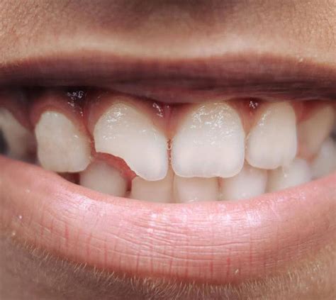 broken teeth mosman smiles dental