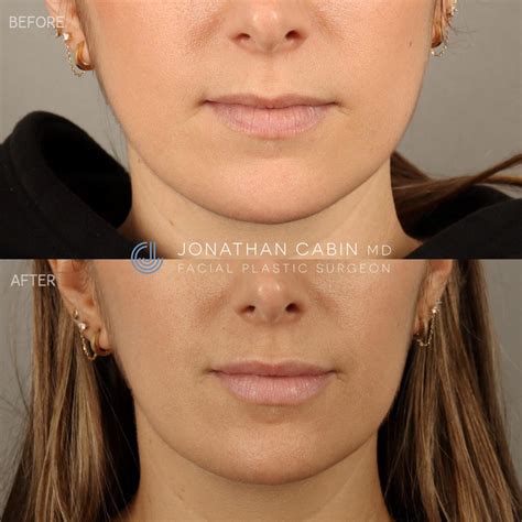 non surgical procedures for face