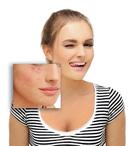 Premium Photo | Post Acne Marks Treating Acne Scars Acne Scar Removal