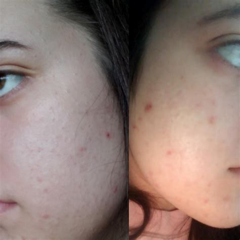 [Acne] numerous CCs, small blackheads, etc. what should i do to help ...