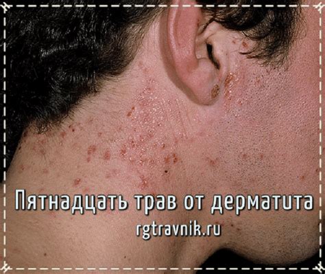 Как выглядит дерматит на ягодицах фото