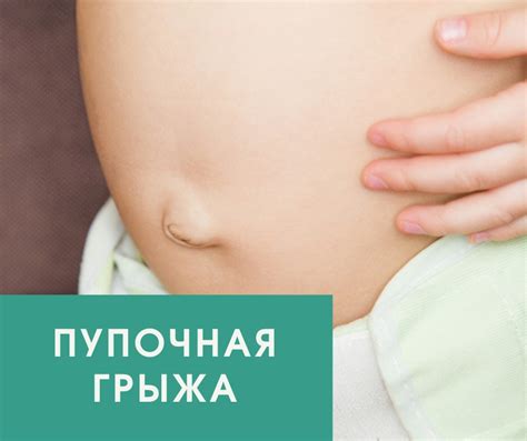Пупочная грыжа. У ваших детей была? 2023 | ВКонтакте