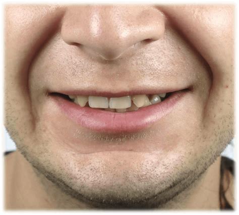 Smile Designing | Joshua Anthony – Richardson's Plastic Surgery Hospitals