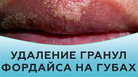 Удаление гранул Фордайса на губах - YouTube