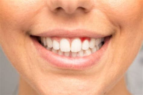 5 Symptoms of Periodontal Disease and Why You Shouldn’t Ignore Them ...